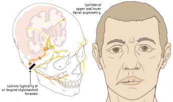 {Bell's Palsy}