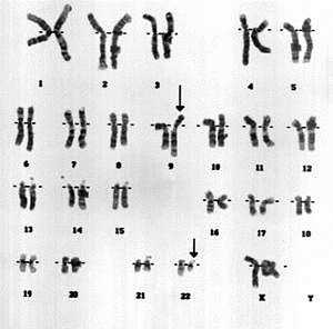 {The Philadelphia Chromosome}