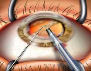 {Cataract Extraction}