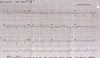 {Electrocardiogram}