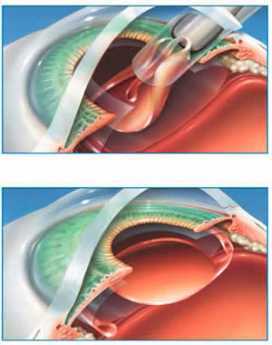 {Cataract Surgery}