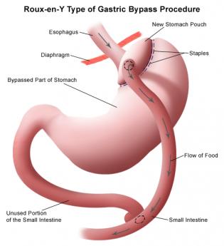 {gastric surgery}