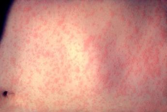 https://www.philadelphia-reflections.com/images/measles,.JPG